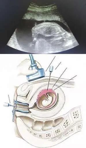 绒毛穿刺是怎么做的过程,穿刺痛苦过程