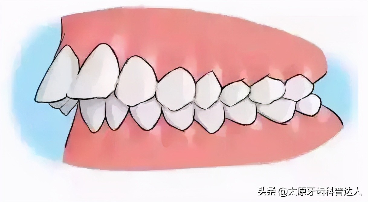 嘴凸龅牙闭不上嘴咋办,有龅牙怎么办