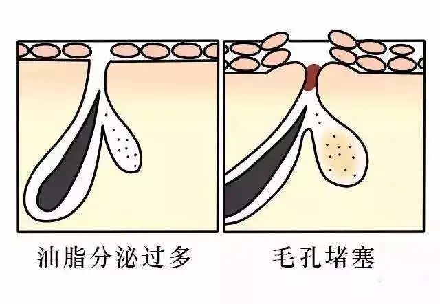 想收缩毛孔的正确方法,毛孔大如何用医美解决