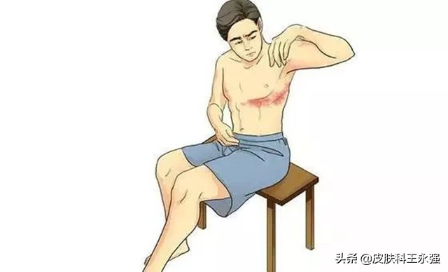 缠腰龙神经痛去医院挂什么科,缠腰龙疼得受不了怎么办