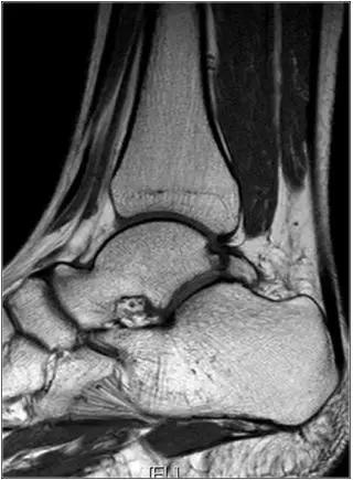 踝关节撞击症问诊,踝关节撞击综合征的x线表现
