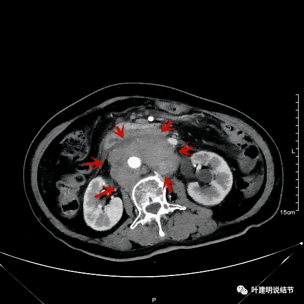特瑞普利单抗食管癌成功案例,特瑞普利单抗治疗食管癌效果好吗