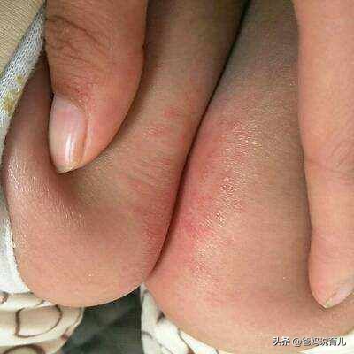 宝宝红屁股反复抹什么药,宝宝反复红屁股怎么办
