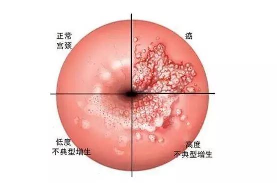 一文带你了解：TCT和HPV的区别！
