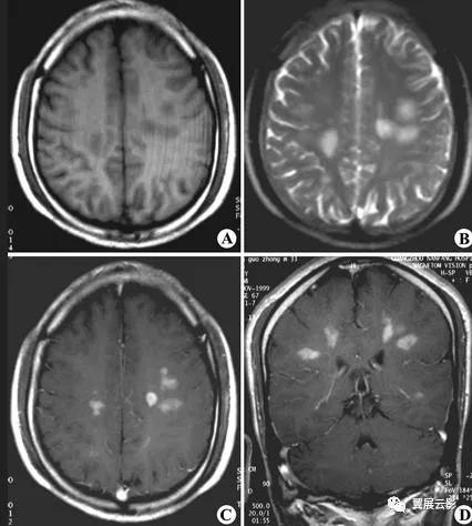 脑部脓肿怎么治疗,多发性脑脓肿能自愈吗