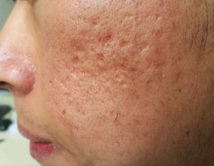 痘痘没了又长怎么解决,痘痘没了毛孔很大怎么办