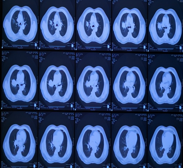 局部放疗能彻底治好吗,放射治疗全过程两大阶段