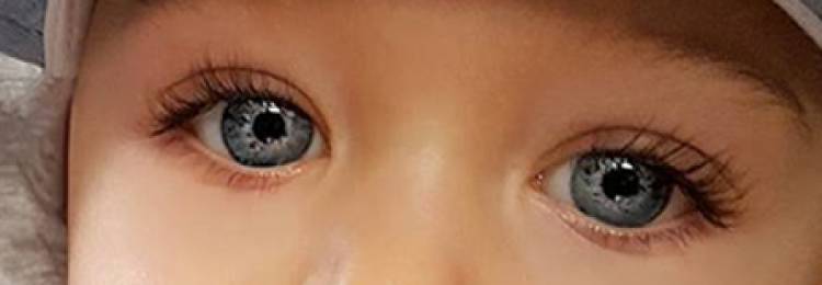 倒睫会影响儿童视力吗,倒睫手术全麻对孩子有影响吗