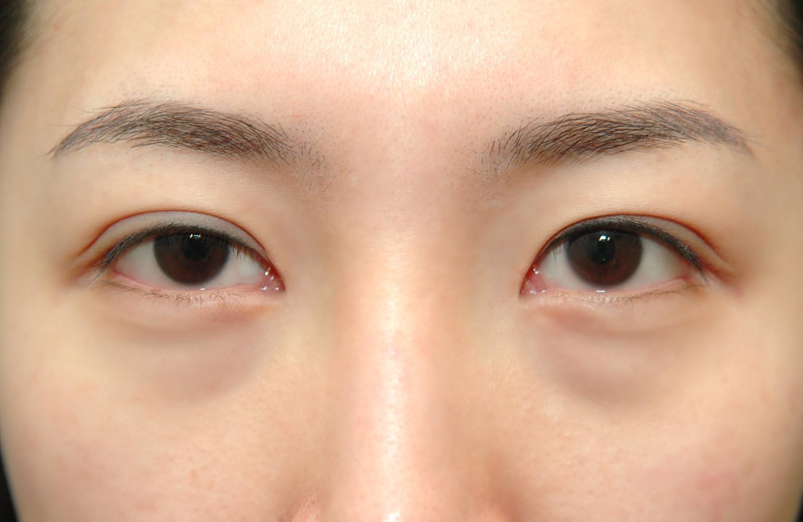 眼袋重显老去眼袋的方法,眼袋很重怎么治