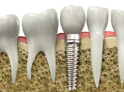 口腔类各项术后注意事项,口腔各种操作后护理注意事项