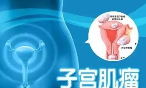 绝经期子宫肌瘤5.6厘米需要手术吗,我43岁有子宫肌瘤