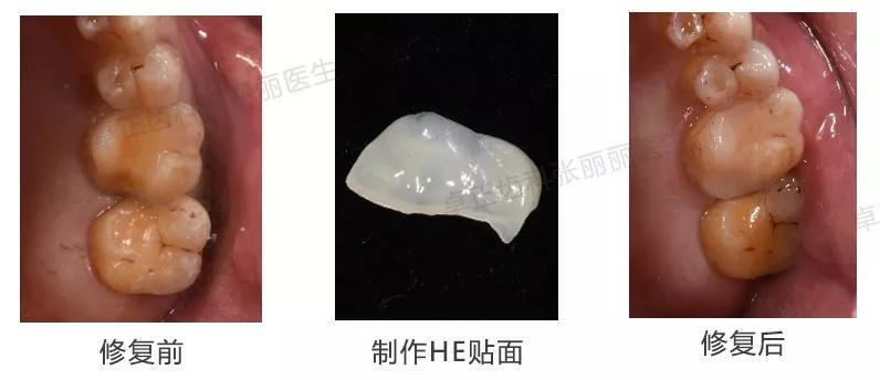 牙齿缺损全瓷冠修复多少钱,牙齿楔状缺损修复大概多少钱