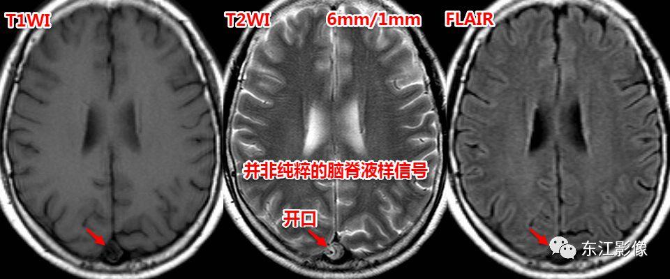 头颅mri扫描影像哪里找,头颅影像mra详细解说