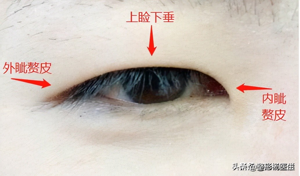 整形医生科普割双眼皮必看攻略,割双眼皮一定好看吗
