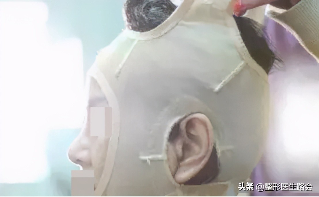 拉皮去法令纹怎么去除最安全永久,做拉皮能去除法令纹能坚持多久