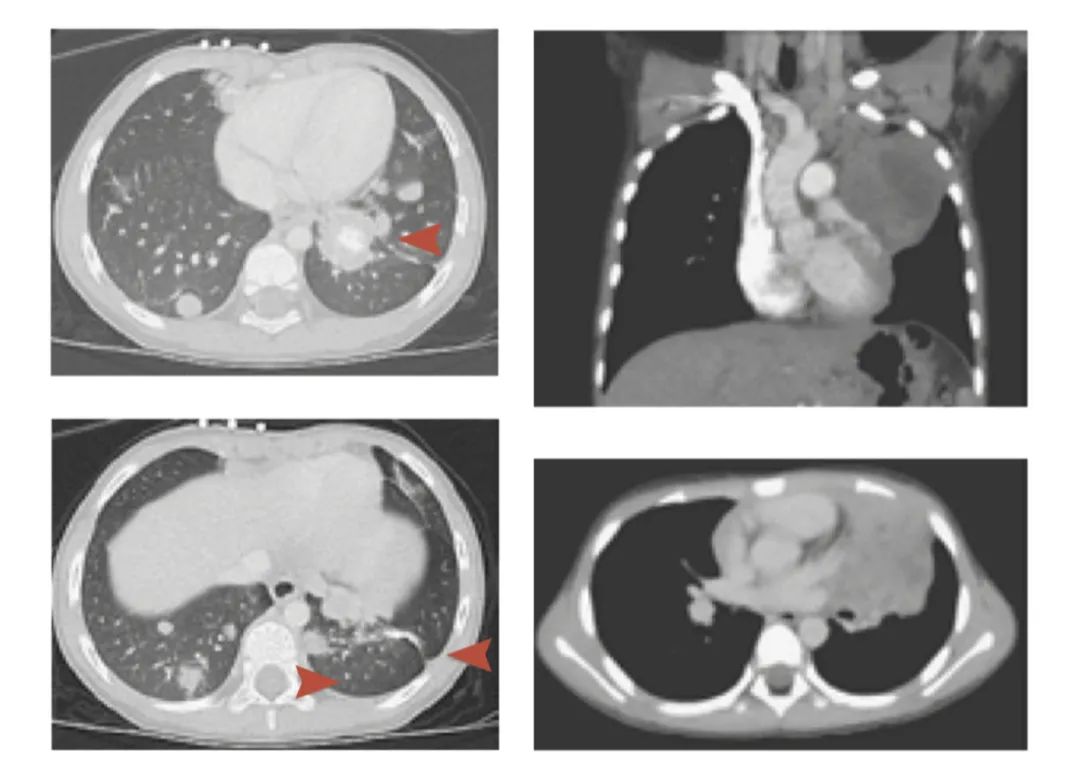 母亲顺产导致婴儿吸入癌细胞,2岁婴儿小细胞肺癌