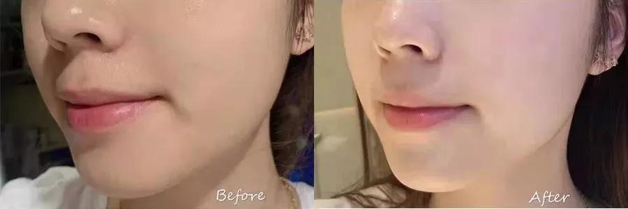 祛痘淡斑美白神器,2毛钱淡斑