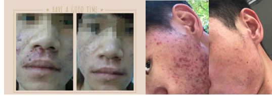 *疮痤**惹人恼，你了解多少？