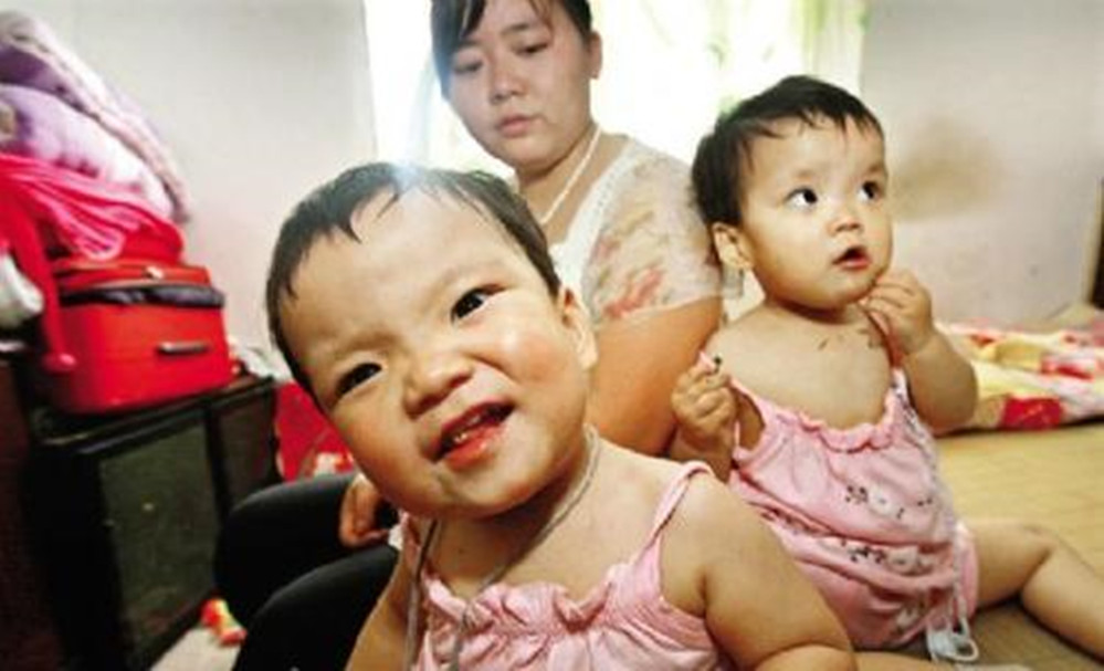 双胞胎坐骨连体成功案例,坐骨连体姐妹分离成功了吗