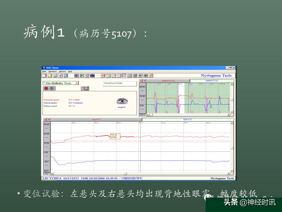 良性位置性眩晕诊断和治疗指南,良性阵发性位置性眩晕的诊断标准