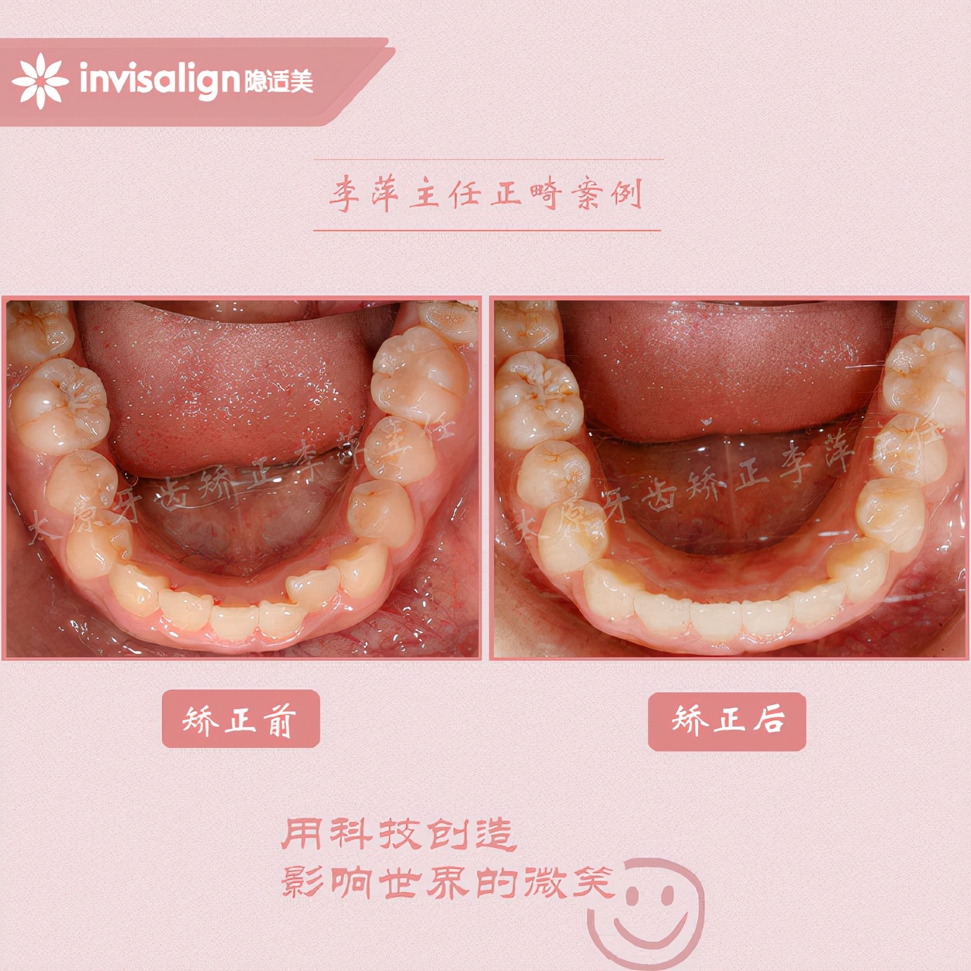 太原牙齿隐形矫正,太原牙齿正畸贵吗