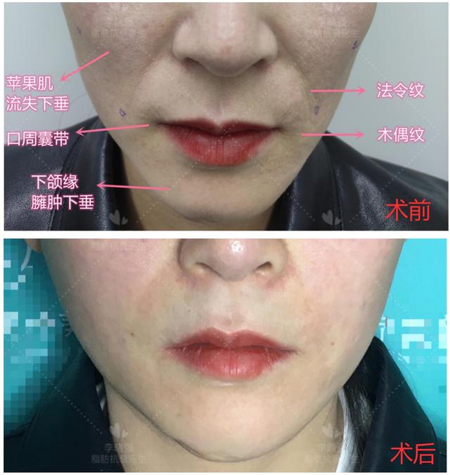 女生面部凹陷自救,女生面部凹陷