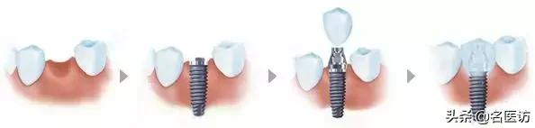 种植牙丨缺牙、补牙——你的口腔健康