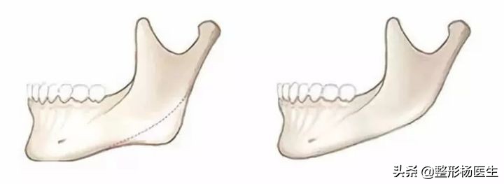 改变脸型除了削骨还有其他办法吗,国字脸磨骨成瓜子脸