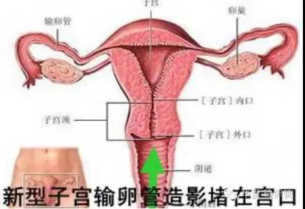 特色诊疗：无痛动态子宫输卵管造影