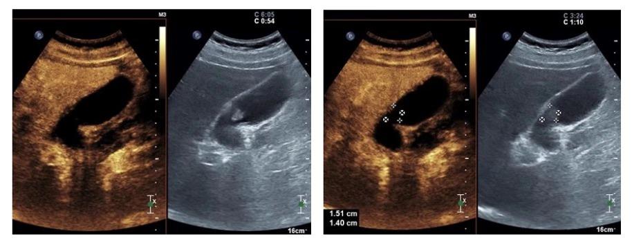 胆囊息肉消融保胆有效吗,胆囊息肉消融保胆有用吗