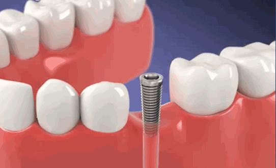 日照口腔牙齿矫正费用,日照牙科修牙多少钱一颗