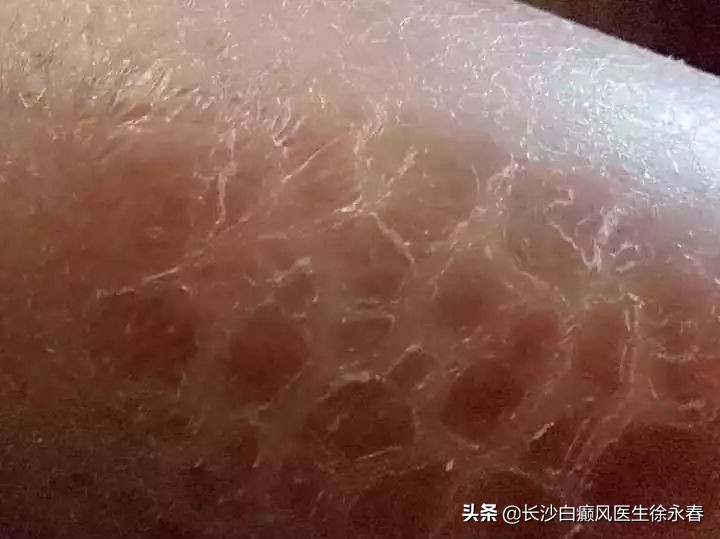 蛇皮肤擦什么药膏,蛇皮肤怎么彻底消除