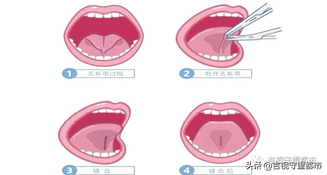 孩子说话有点大舌头要矫正吗,孩子讲话有点大舌头应该看什么科