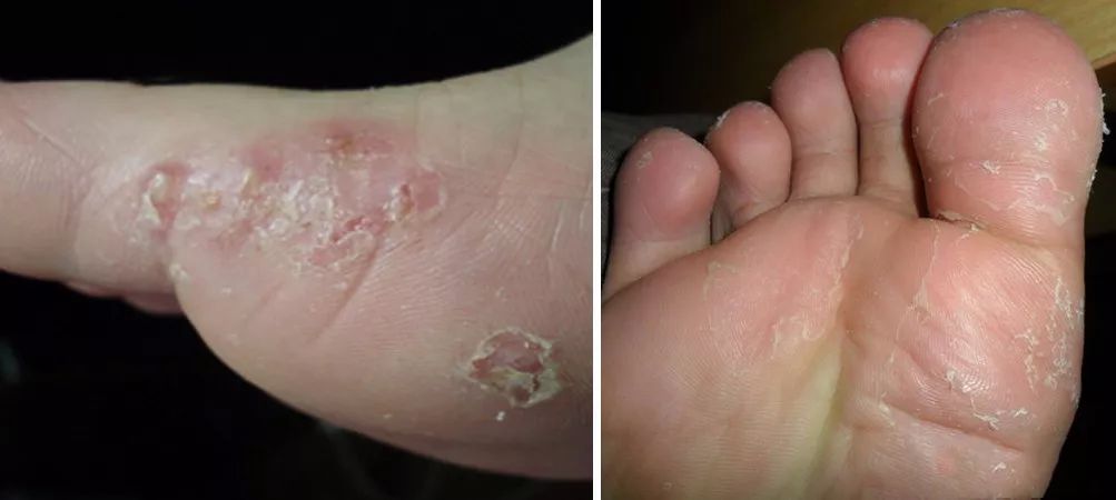 脚气特别痒用什么泡脚效果好,脚气脚臭脚痒的克星用什么