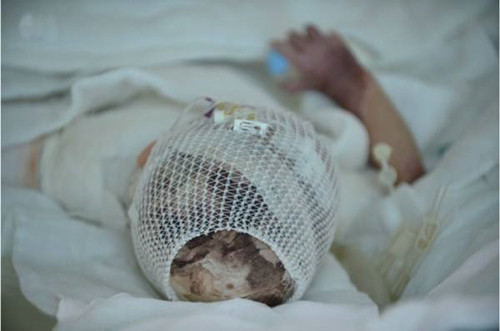 一岁宝宝大面积烫伤住院,小孩大面积严重烫伤50%