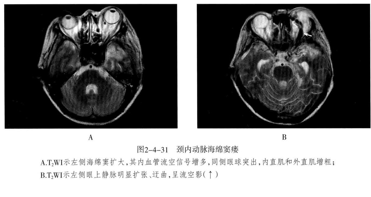 颅内血管周围间隙的影像鉴别,颅脑血管源性疾病影像诊断