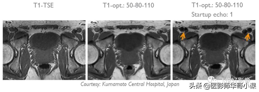 飞利浦磁共振序列参数解读,飞利浦磁共振快速扫描方案指南