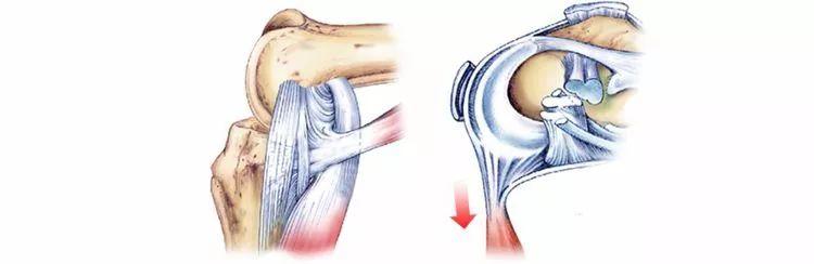 有关半月板的8个问题，给你最详细的解答