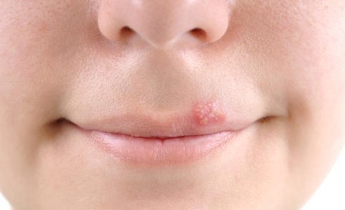 红霉素软膏治什么病最便宜,红霉素软膏价格不同效果不一样吗