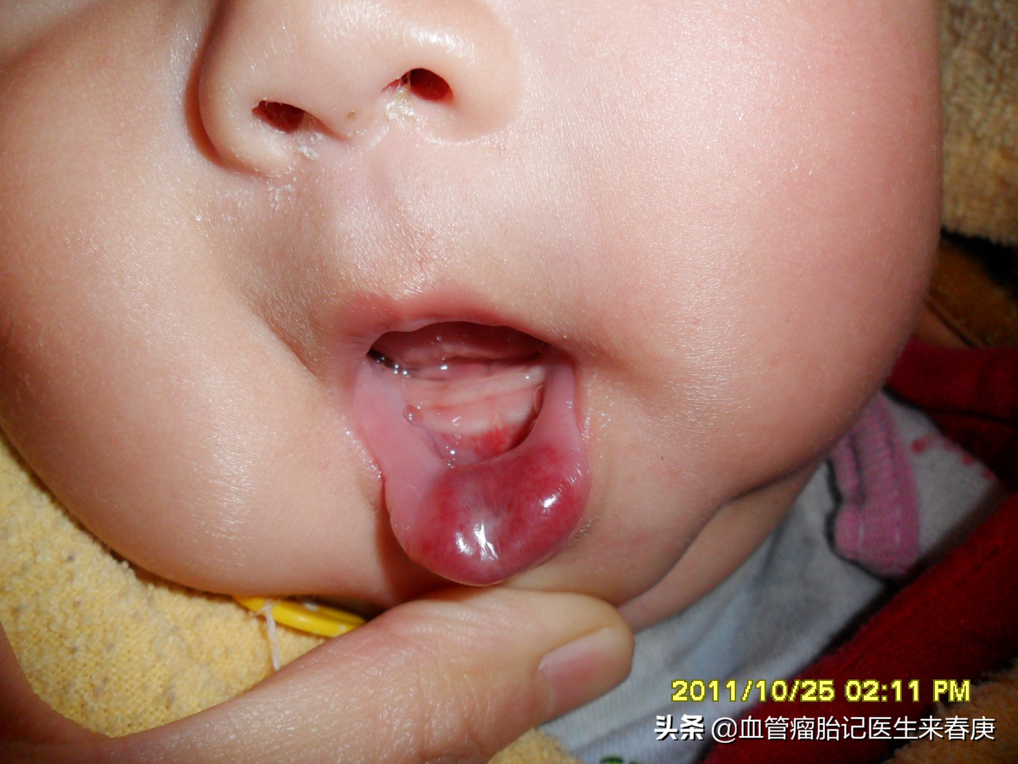 什么样的血管瘤可以观察,血管瘤的预防应该从哪些方面做起