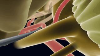 面肌痉挛手术费用成功率是多少,面肌痉挛3d超微创定位修复术