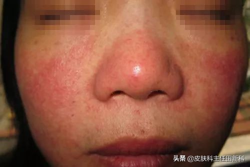 痘印变成斑点怎么治,痘印的种类以及成因你了解多少