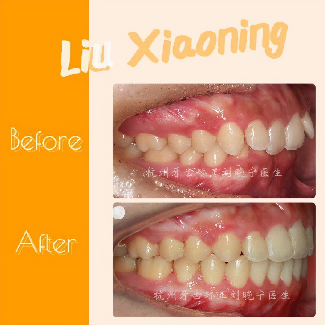 矫正牙齿如何改善露龈笑,矫正牙齿可以改善露龈笑吗