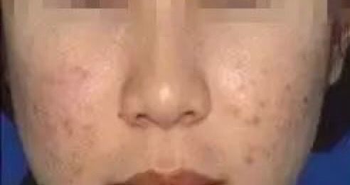 如何有效祛除痘印简单方法,怎么有效简单的祛除痘印的方法