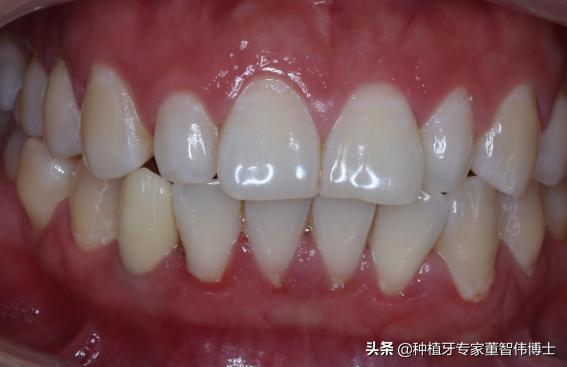 全冠修复与种植区别,全口即刻种植修复详细流程介绍