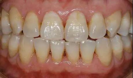 楔状缺损坑,较深的楔状缺损