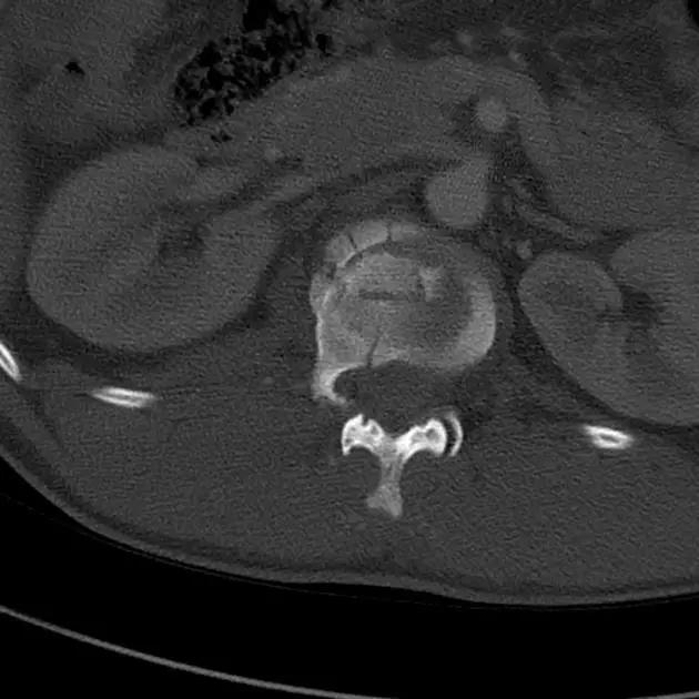 几种严重骨折医学名称,常见的骨折有哪些名称