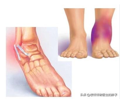 踝关节扭伤注意事项有哪些,踝关节轻微扭伤也会再次扭伤吗