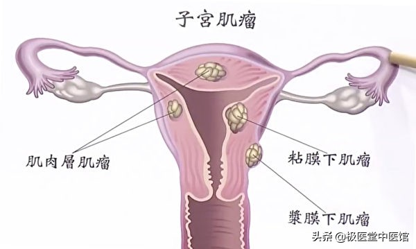 子宫肌瘤吃什么药膳,子宫肌瘤吃什么中草药好得快