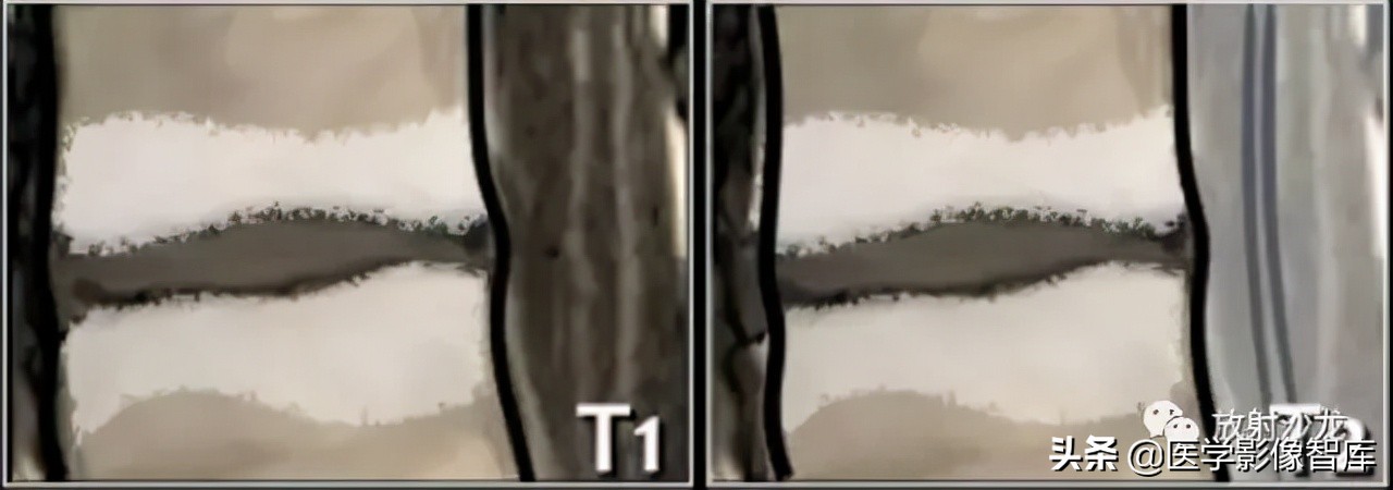 一键收藏所有的内容,颈椎间盘病变的症状和治疗